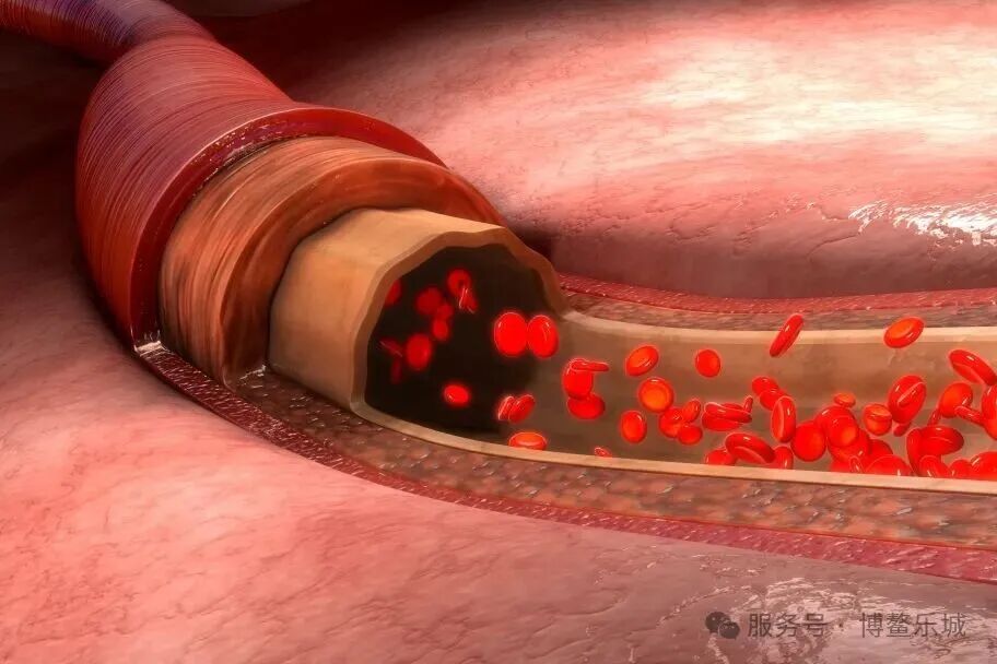 Lipid and flow inside a vessel