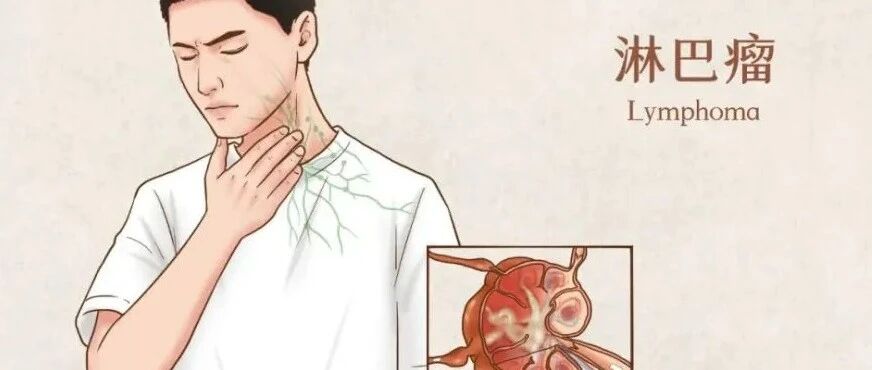 Lymphoma explainer graphic