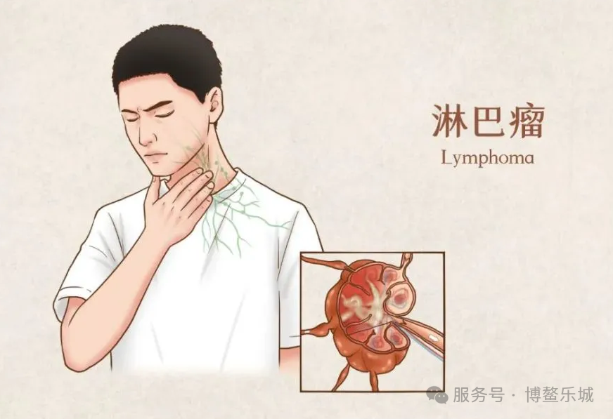 Lymphoma and cervical nodes illustration