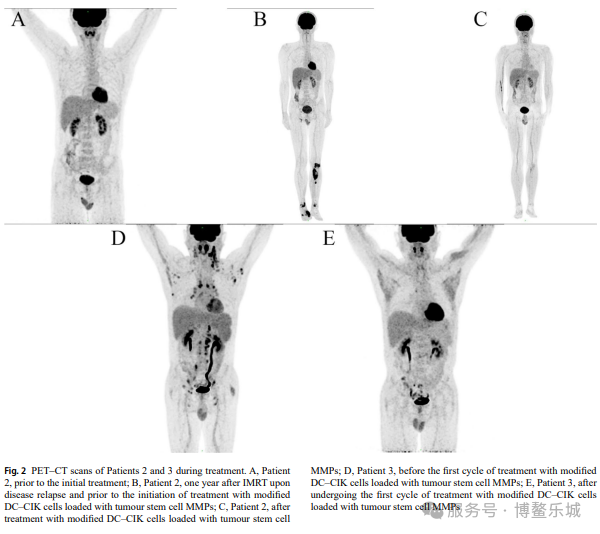 PET-CT before and after treatment